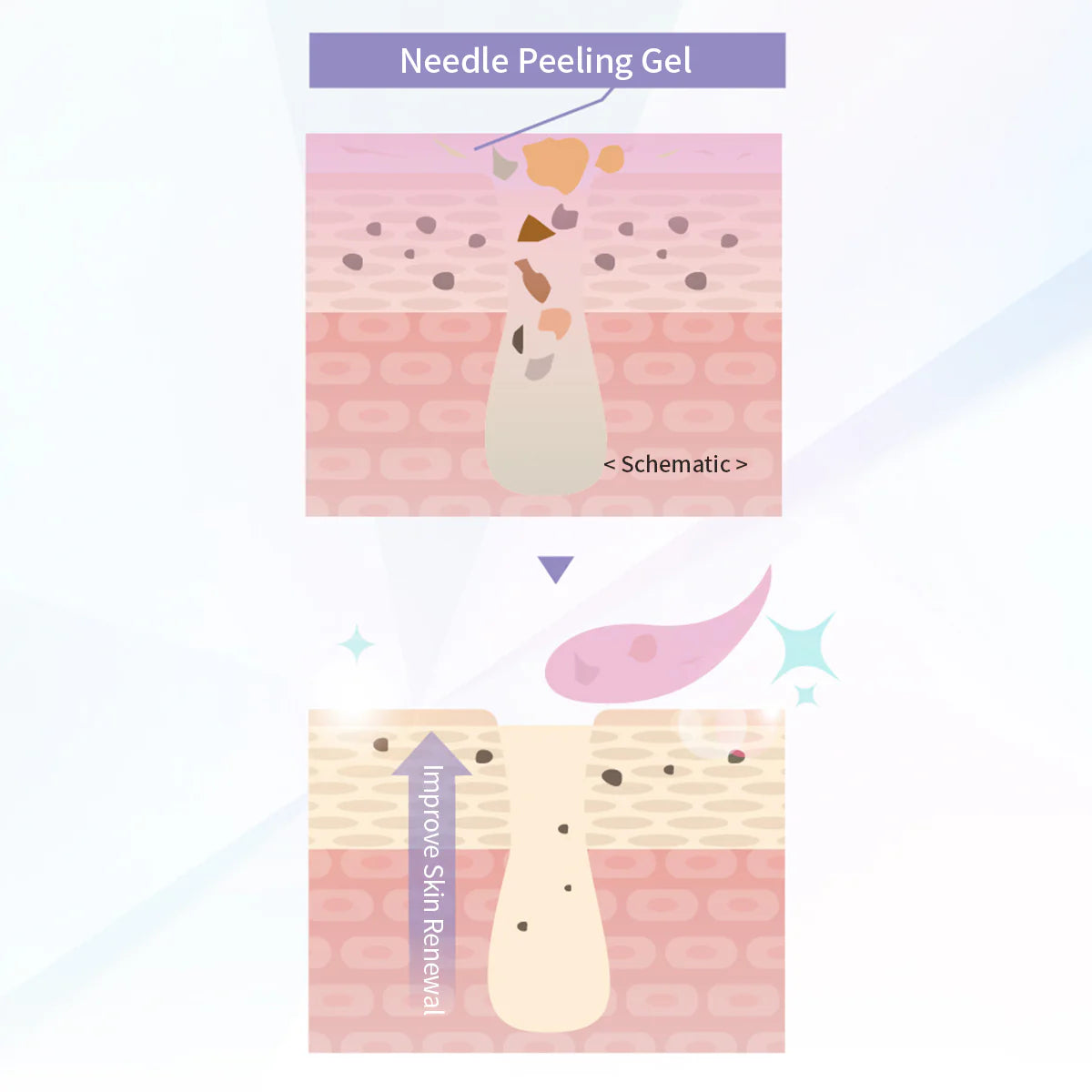 Fractional CC Needle Peeling Gel